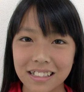 白間美瑠（みるるん）が整形か画像比較｜注目は「目」「鼻」