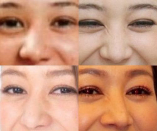 SHELLYの鼻
