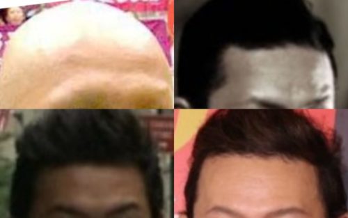 中村獅童のおでこ